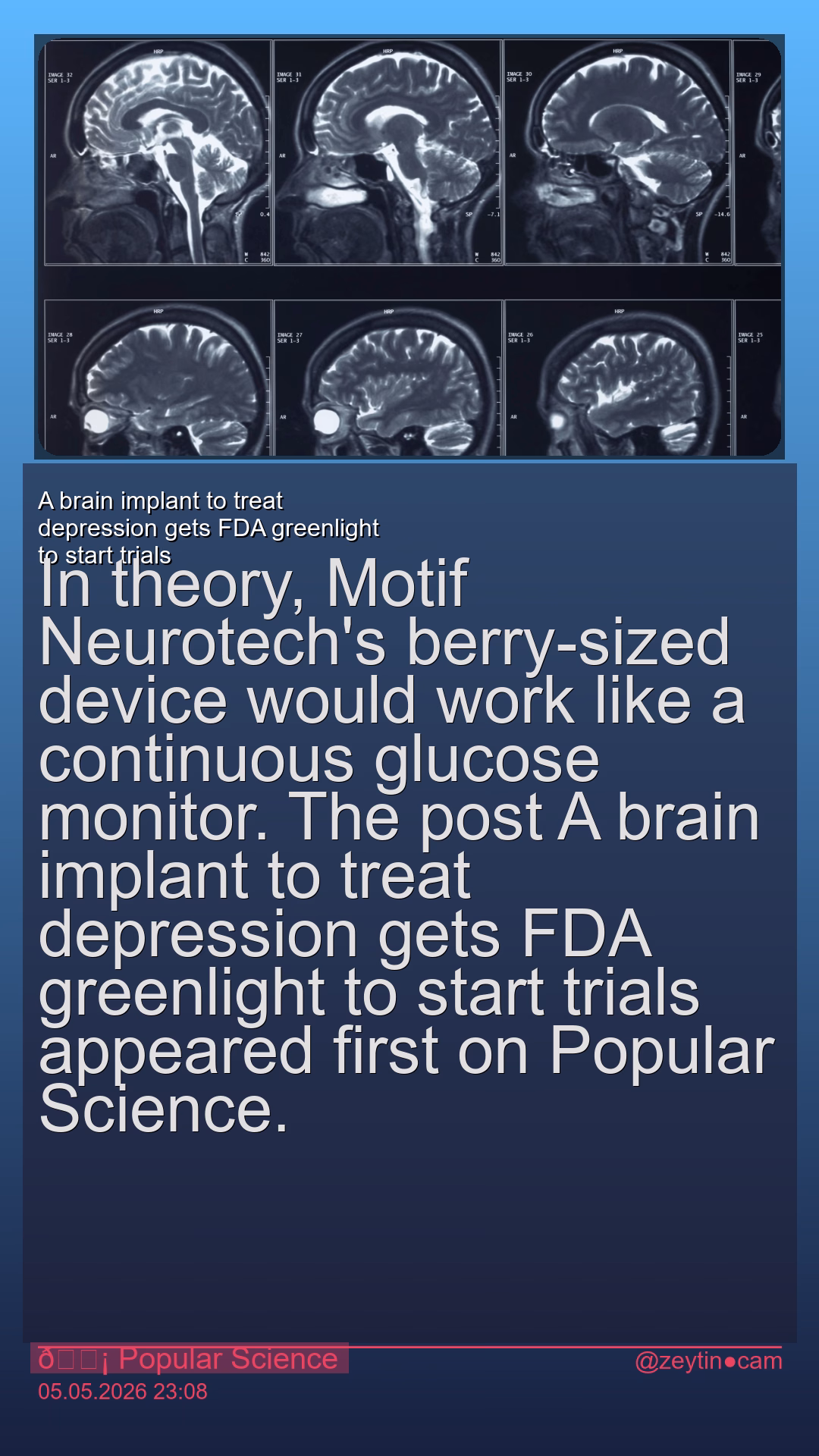 A brain implant to treat depression gets FDA greenlight to start trials
